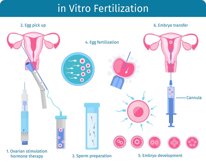 Process of IVF