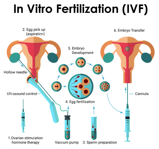  process of In vitro fertilization explained by IVF expert