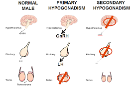 primary and secondary hypogonadism-IASH India