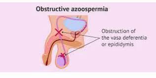 obstructive azoospermia causes -IASH India
