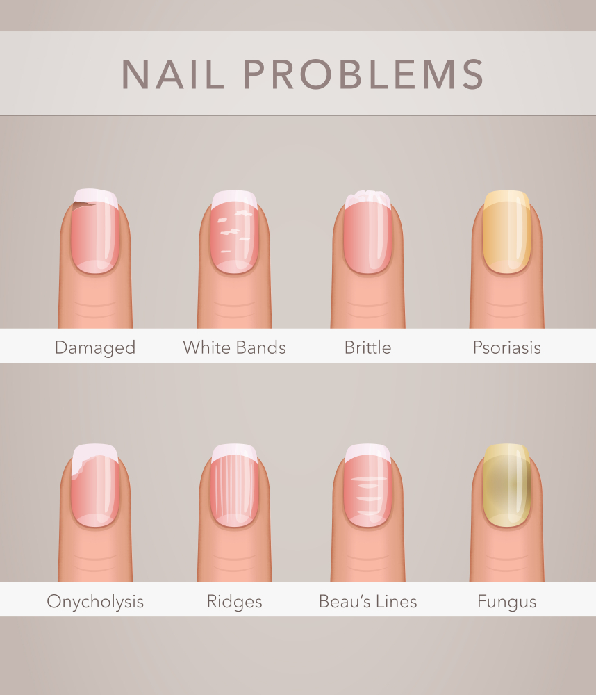 Long time nail problems